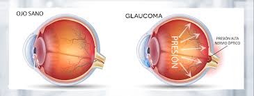 Fisiología del glaucoma